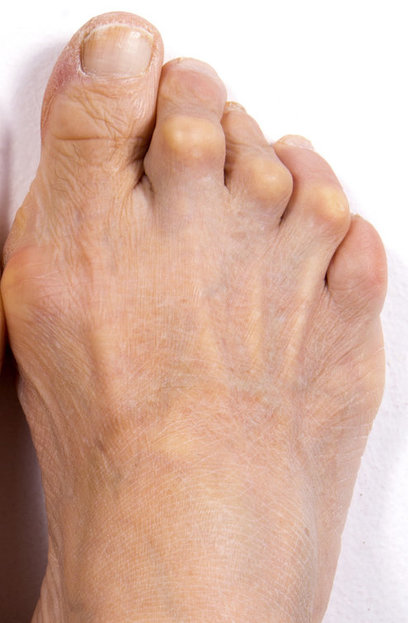 Dr. Warren E. Kaplan D.P.M. | Dr. Adam H. Kaplan D.P.M. | Bunions in ...